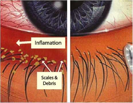 Blepharitis