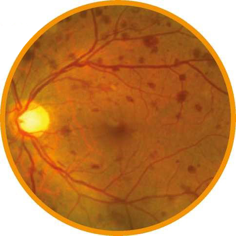 Diabetic retinopathy