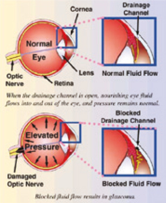 Glaucoma