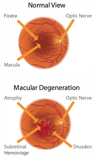 Macular degeneration